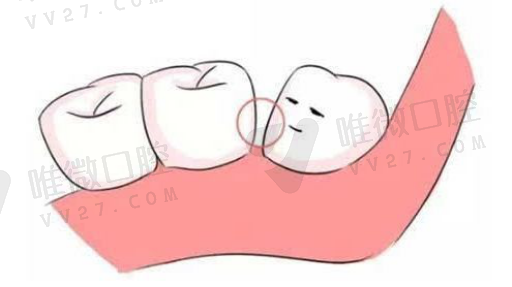 特别适用于制作可摘局部义齿（可摘局部义齿恢复功能的部分是）(图1)